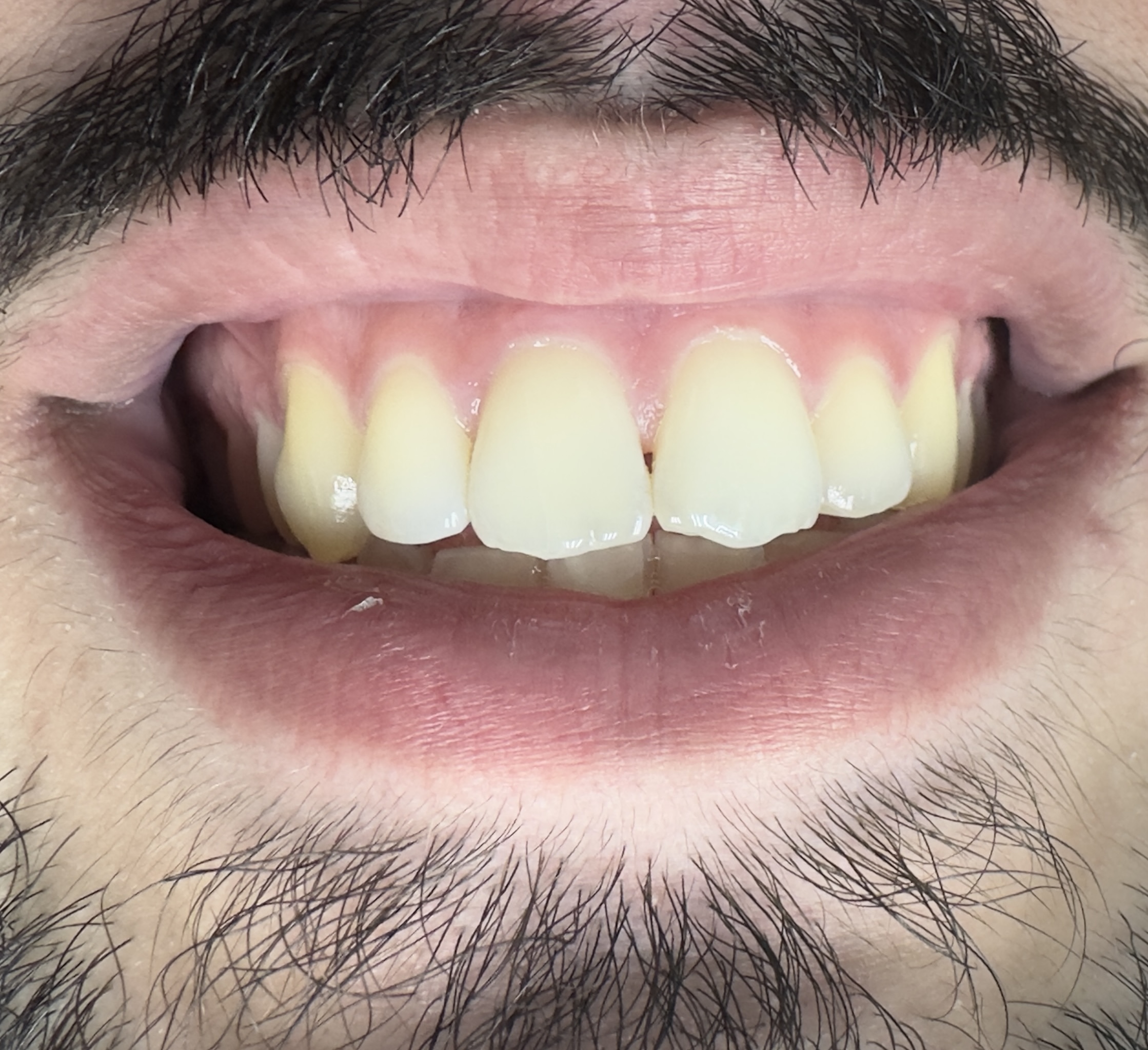 Cosmetic dentistry — before