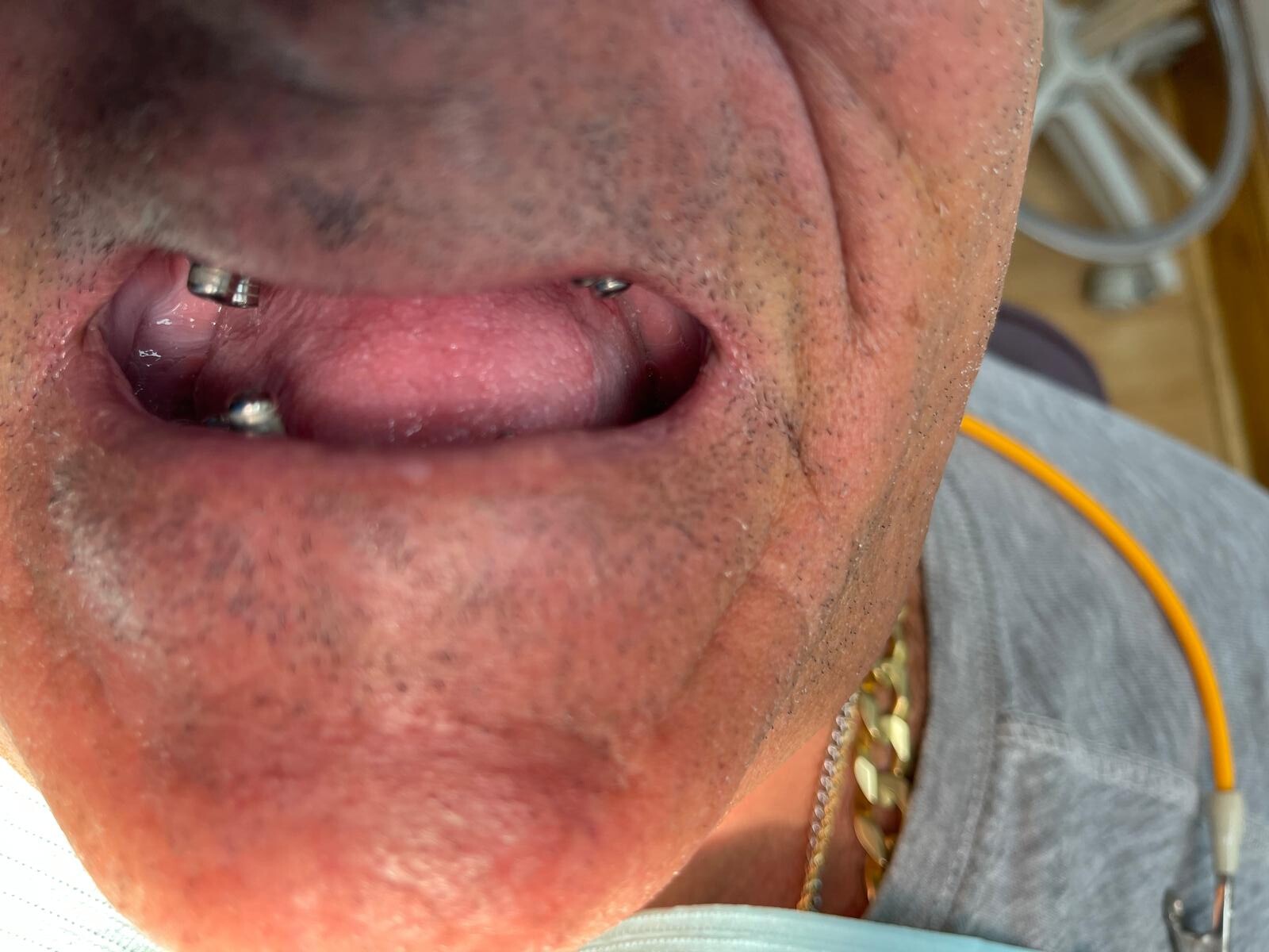 Dental implants — before