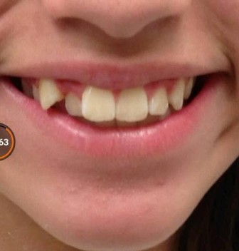 Braces & Invisalign — before